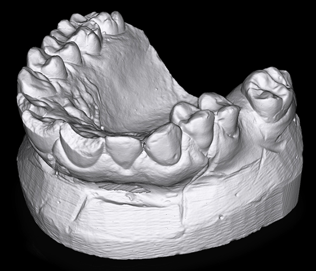 An HDI Compact C109 scanner was used to scan this image of a dental mold. Image courtesy of Polyga Inc.
