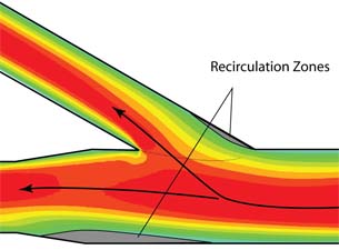 Medical Applications Tap Power of CFD